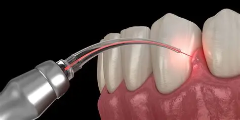 Laser Dentistry